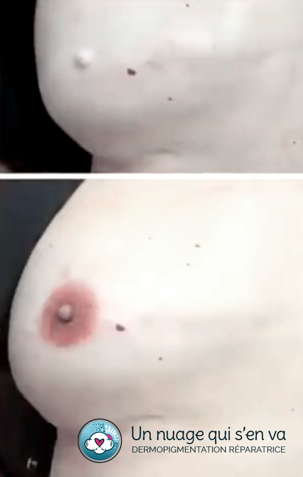 Technique de l'areole 3D